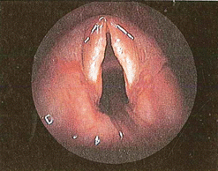 Figura 11 - macroscopiche patologie nodulari