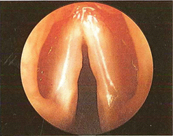 Figura 12 - macroscopiche patologie nodulari