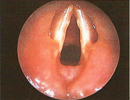 Figura 13 - macroscopiche patologie nodulari