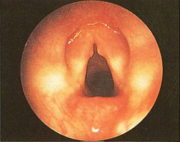 Figura 15 - macroscopiche patologie nodulari