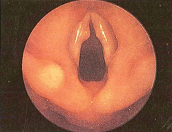 Figura 9 - macroscopiche patologie nodulari